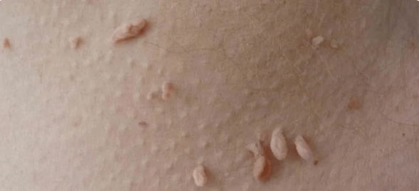 Způsob přenosu HPV