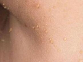 důvody pro výskyt papilomů na těle