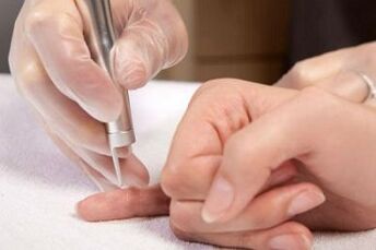 jak se zbavit papilomů na těle