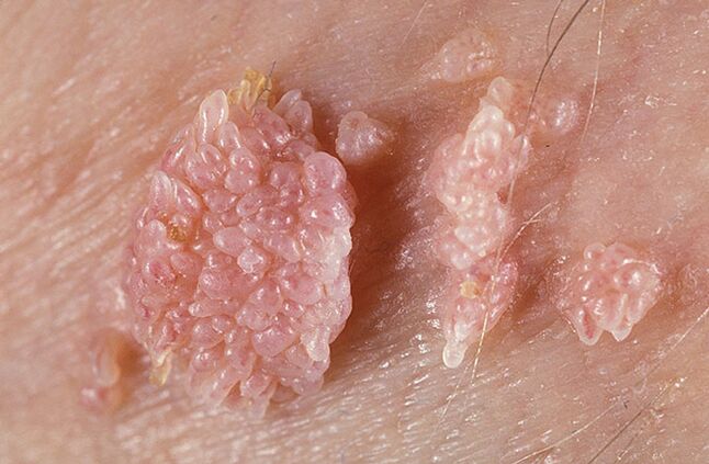 Papilom je benigní nádorová formace kůže a sliznic bradavičnaté povahy