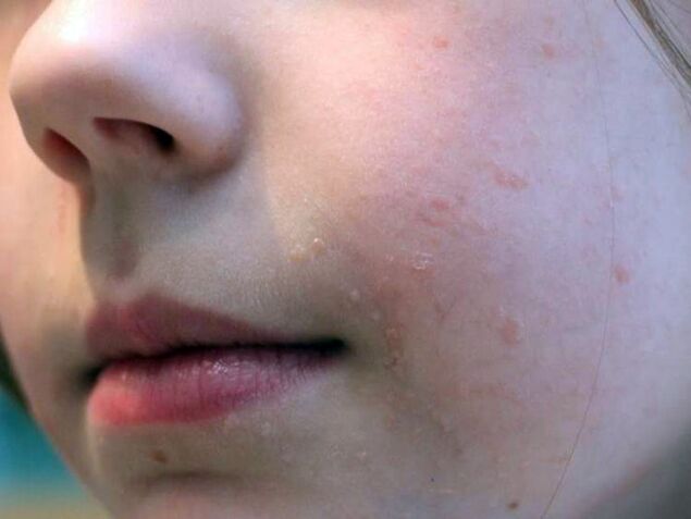 Ploché bradavice na obličeji se nejčastěji objevují v období dospívání